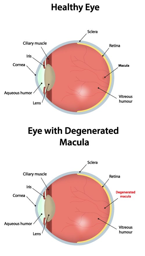 macular degeneration blindness dry eye central vision loss