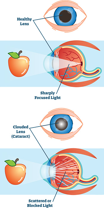 cataract clouding natural lens in eye