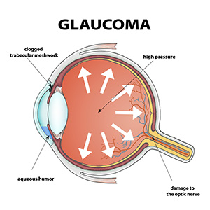 Glaucoma